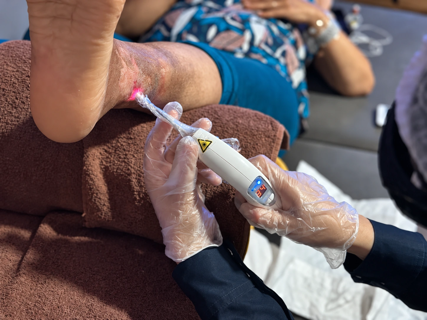 Aplicação pontual de laser no calcanhar